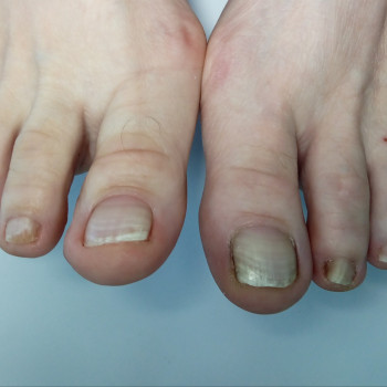 Медичний педикюр
                    Подолог Тетяна Каменец-Подольский