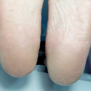 Медичний педикюр
                    Подолог Тетяна Каменец-Подольский