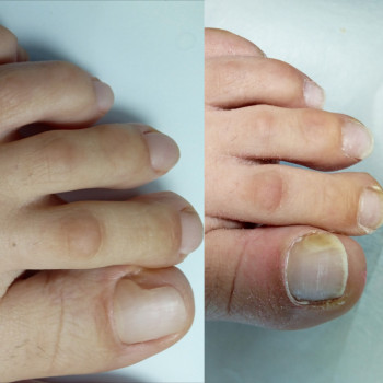 Медичний педикюр
                    Подолог Тетяна Каменец-Подольский