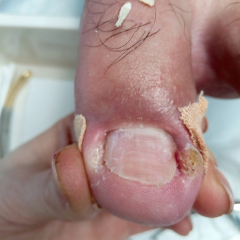 Медичний педикюр
                    Подолог Тетяна Каменец-Подольский