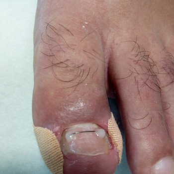 Медичний педикюр
                    Подолог Тетяна Каменец-Подольский