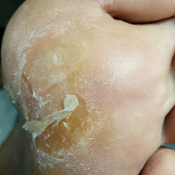 Медичний педикюр
                    Подолог Тетяна Каменец-Подольский