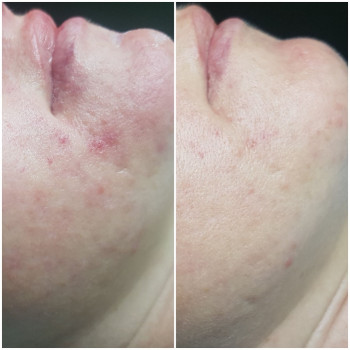 Лечение Акне
                    Косметолог Жанна Київ