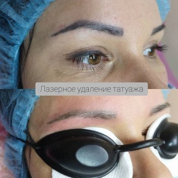 Удаление перманентного макияжа, татуажа
                    Тату салон ALICE tattoo studio Запорожье