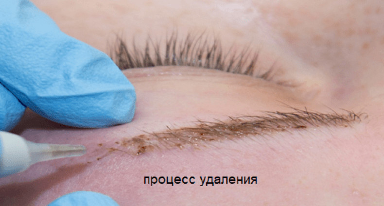 Удаление ремувером, фото - Тату салон ALICE tattoo studio