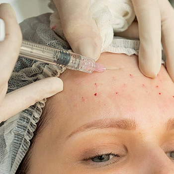 Мезотерапия
                    Косметолог-инъекционист Лилия Киев