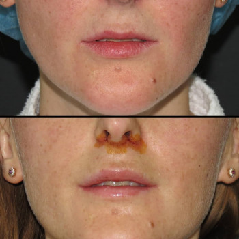 Пастика верхней губы (lip lift + V-Y)