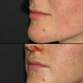 Пастика верхней губы (lip lift + V-Y)