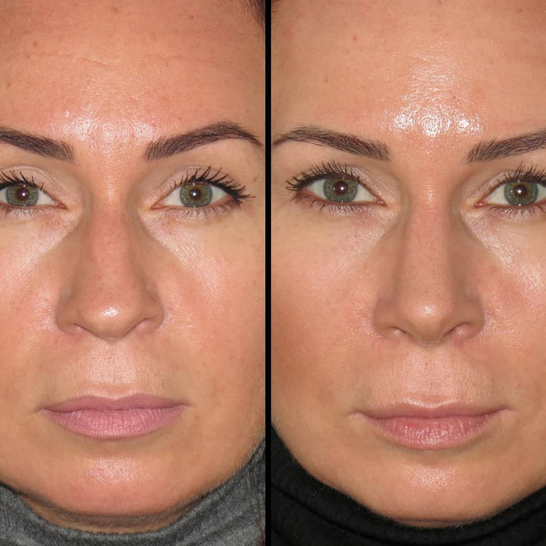 Реконструктивна ринопластика, фото - Пластичний хірург Дмитрий Караванов