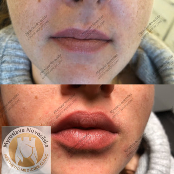 контурна пластика губ