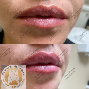 збільшення губ