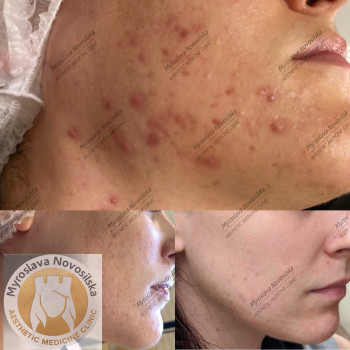 лазерне шліфування шкіри обличчя