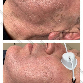 Фракційна лазерна шліфовка шкіри