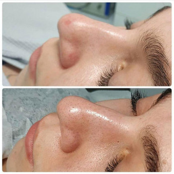 МЕХАНІЧНА ЧИСТКА