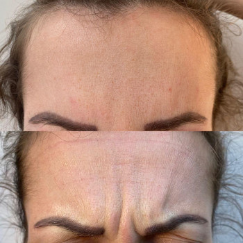 БОТУЛІНОТЕРАПІЯ