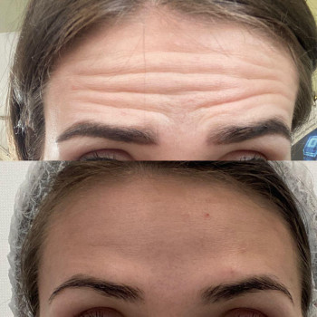 БОТУЛІНОТЕРАПІЯ