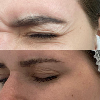 БОТУЛІНОТЕРАПІЯ