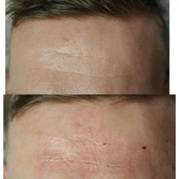 БЛАНШИНГ,
ЗАПОВНЕННЯ ДЕРМАЛЬНИХ ЗАЛОМІВ