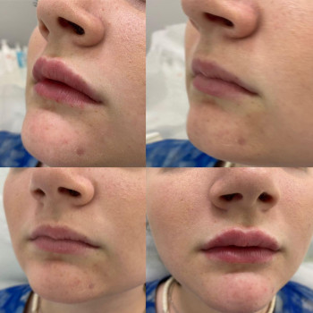 КОНТУРНА ПЛАСТИКА ГУБ ,ІНДИВІДУАЛЬНЕ ПОБАЖАННЯ КЛІЄНТА