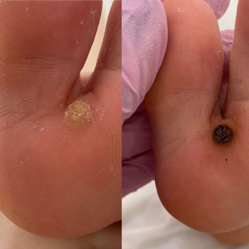 ВИДАЛЕННЯ БОРОДАВОК