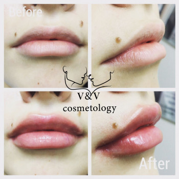 Фото из портфолио косметолога Оксана Вирская (Запорожье)