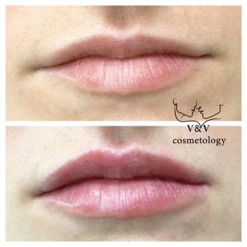 Фото из портфолио косметолога Оксана Вирская (Запорожье)