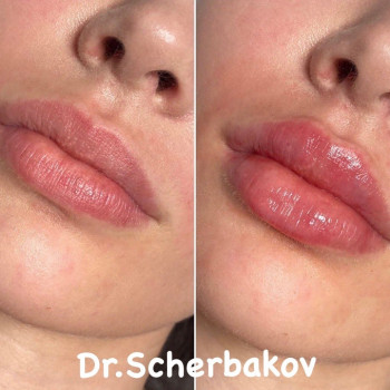 Аугментация губ препаратом Neuramis deep 1 ml.