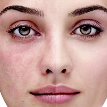 Лазерное elos удаление купероза (сосудистых дефектов)
                    Салон краси NUDE beauty space Київ