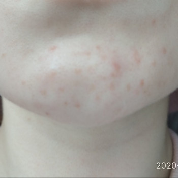 Механічна чистка