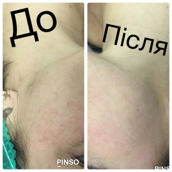 Мікродермабразія