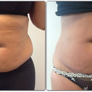 Результат від 3 процедур