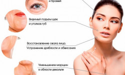 Rf-ліфтинг обличчя та тіла Косметолог Мария Киев