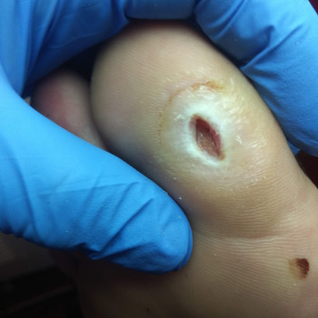 Лечение Диабетической стопы.