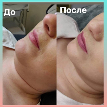 Липолитики+ массаж - отличный дуэт