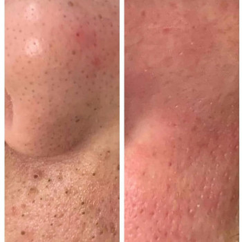 Ферментная чистка лица