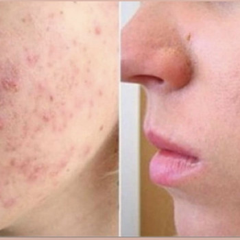 Лікування акне