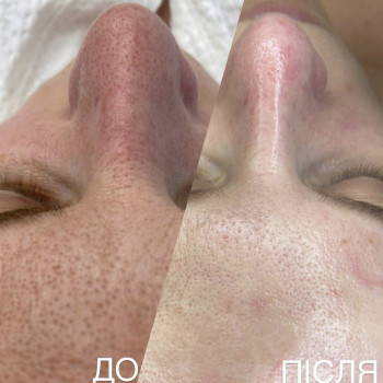 Результат 13-ти етапної безболісної гігієни обличчя за нашим