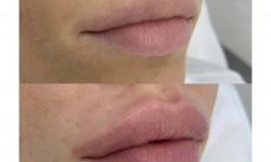 Контурна пластика губ Juvederm Медичний центр Bs lab Львів