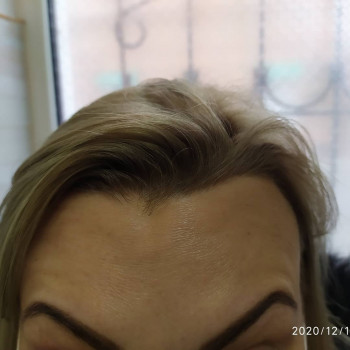 Ботулакс після