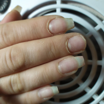 Был сделан ноготок, что не удивительно при такой длине и сро