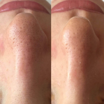 Ультразвуковая чистка лица + сыворотка + альгинатная маска
                    Косметолог Валерия Одеса