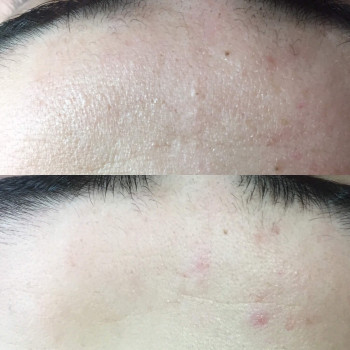 Ультразвуковая чистка лица
                    Косметолог Валерия Одеса