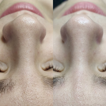 Атравматическая 3D чистка лица
                    Косметолог Валерия Одеса