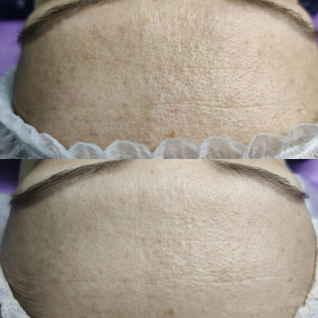 Атравматическая 3D чистка лица
                    Косметолог Валерия Одеса