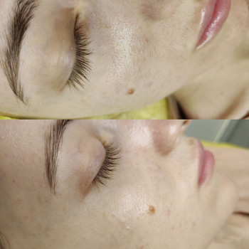 Атравматическая 3D чистка лица
                    Косметолог Валерия Одеса