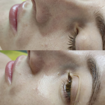 Атравматическая 3D чистка лица + сыворотка + альгинатная маска
                    Косметолог Валерия Одеса