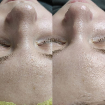 Атравматическая 3D чистка лица + сыворотка + альгинатная маска
                    Косметолог Валерия Одеса