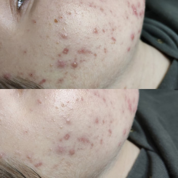 Атравматическая 3D чистка лица + сыворотка + альгинатная маска
                    Косметолог Валерия Одеса