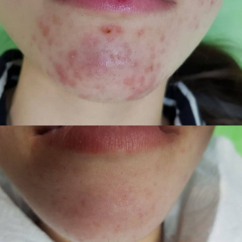 Механическая чистка лица + пилинг
                    Косметолог Валерия Одеса