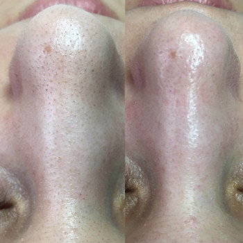 Механическая чистка лица + сыворотка + альгинатная маска
                    Косметолог Валерия Одеса